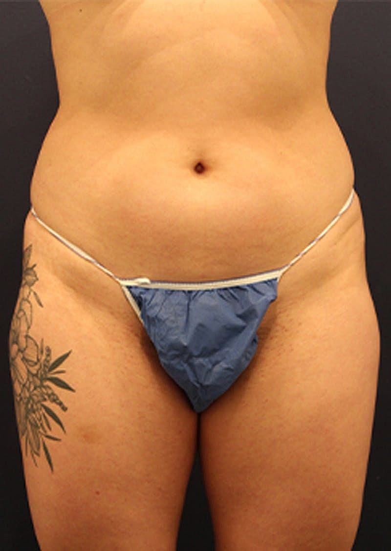 Liposuction Before & After
