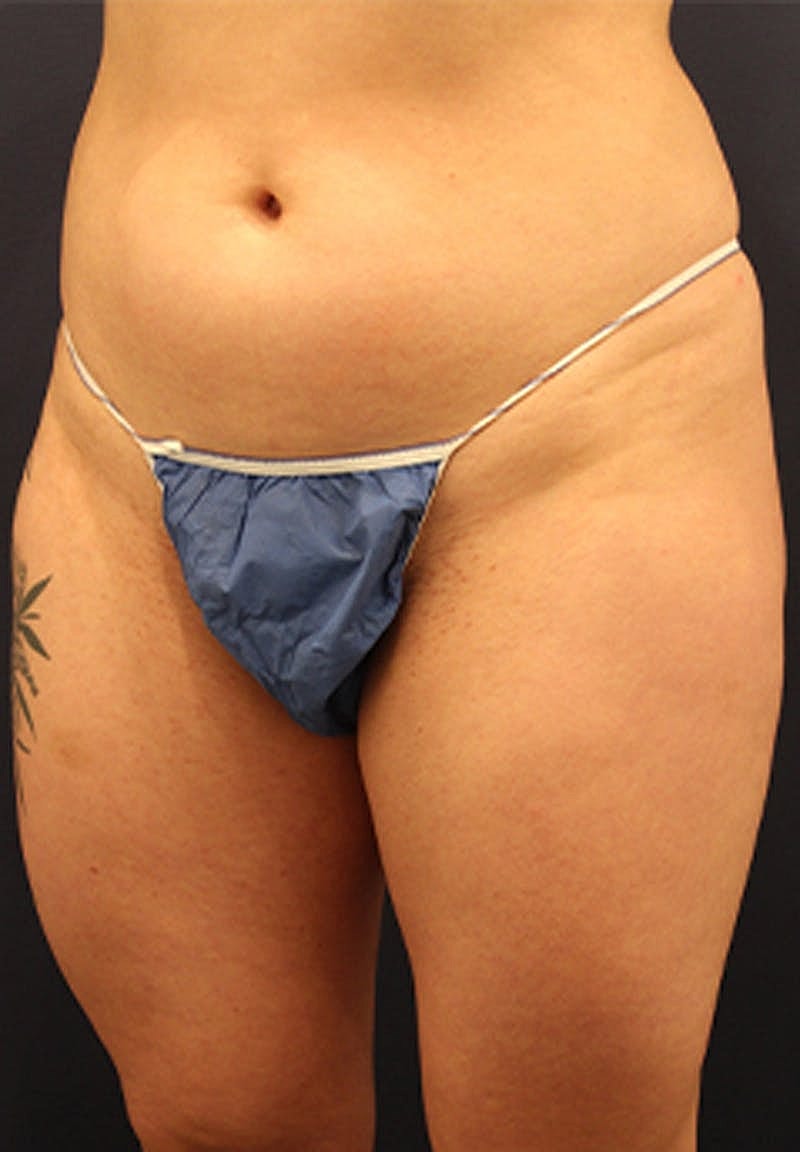 Liposuction Before & After