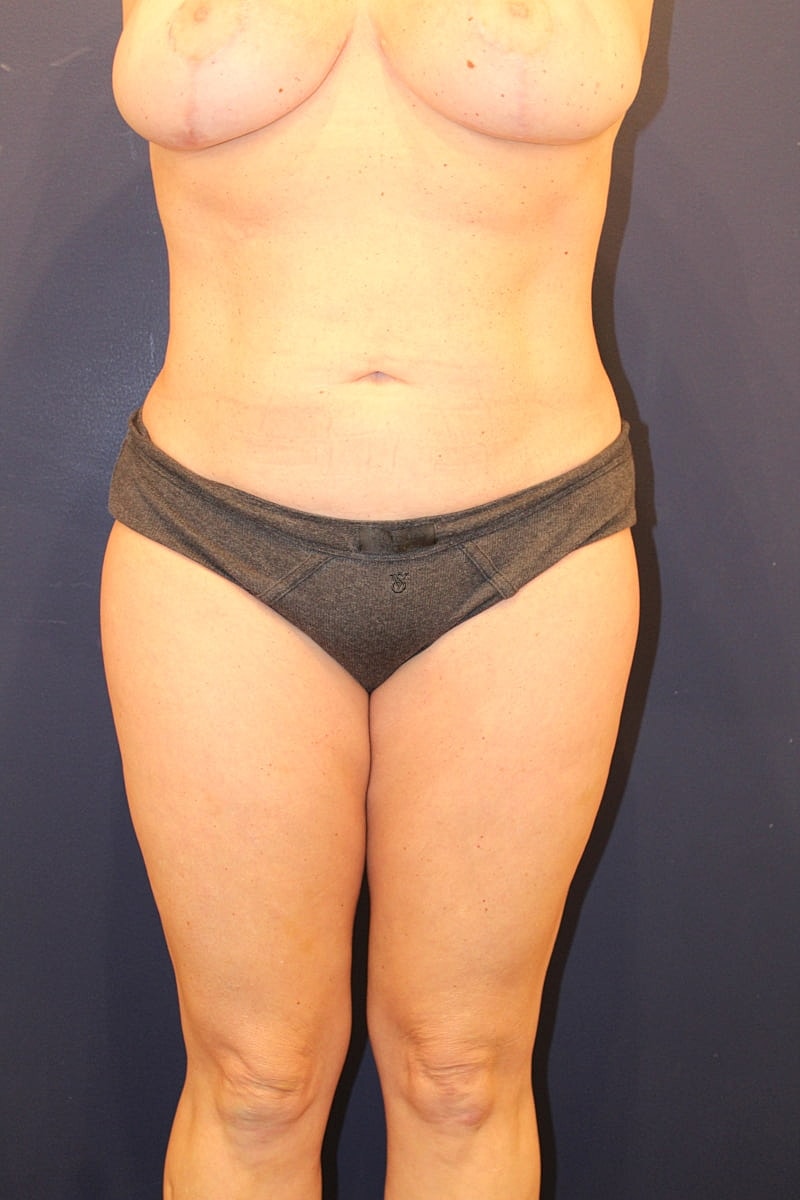 Liposuction Gallery Before & After