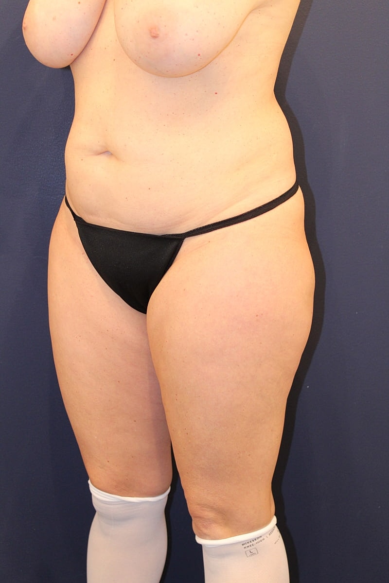Liposuction Gallery Before & After