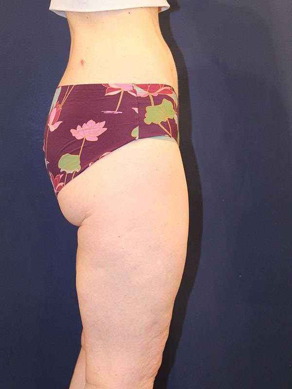 Liposuction Gallery Before & After
