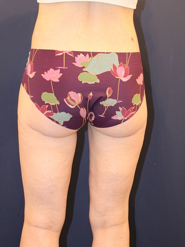 Liposuction Gallery Before & After