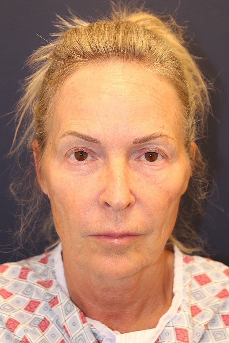 Facelift Before & After
