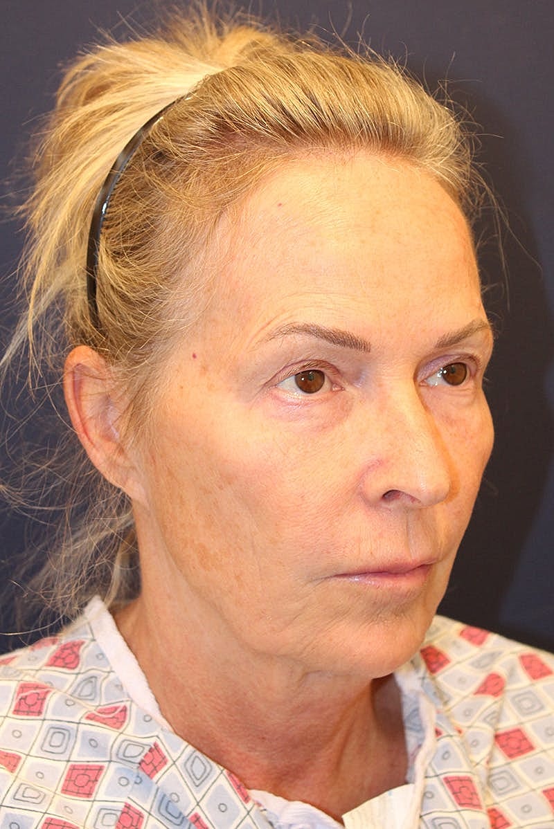 Facelift Before & After