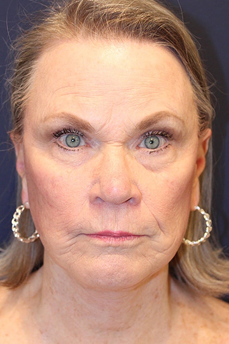 Facelift Before & After