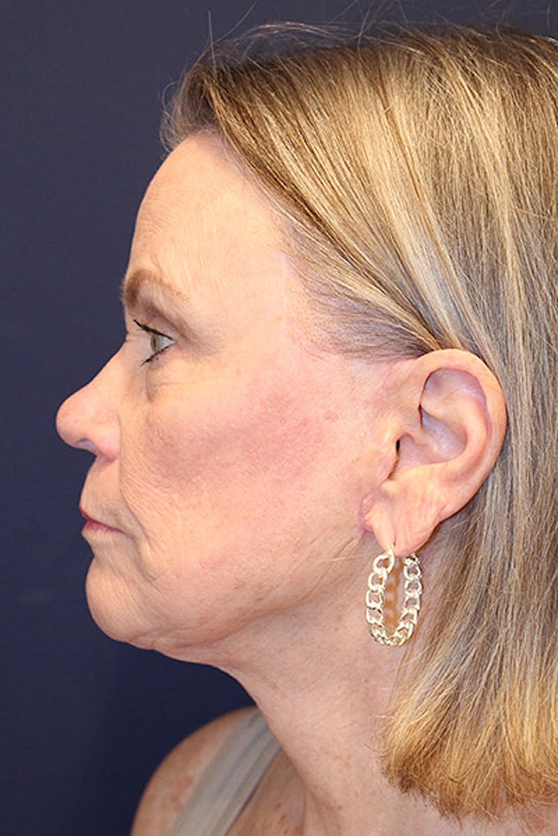 Facelift Before & After