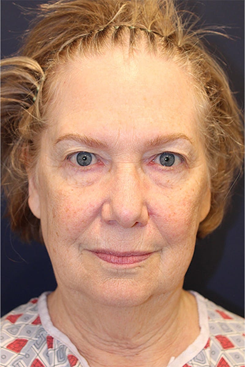 Facelift Before & After