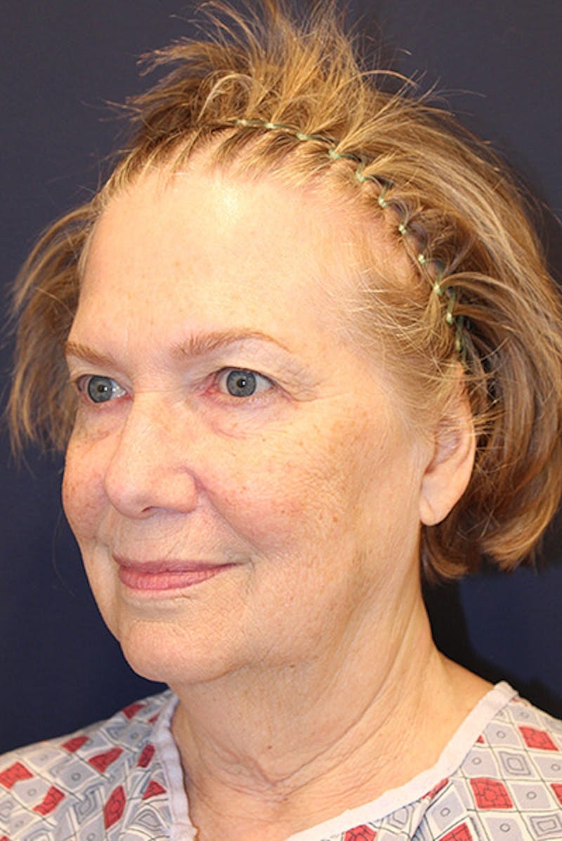 Facelift Before & After