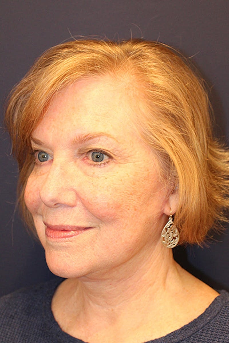 Facelift Before & After