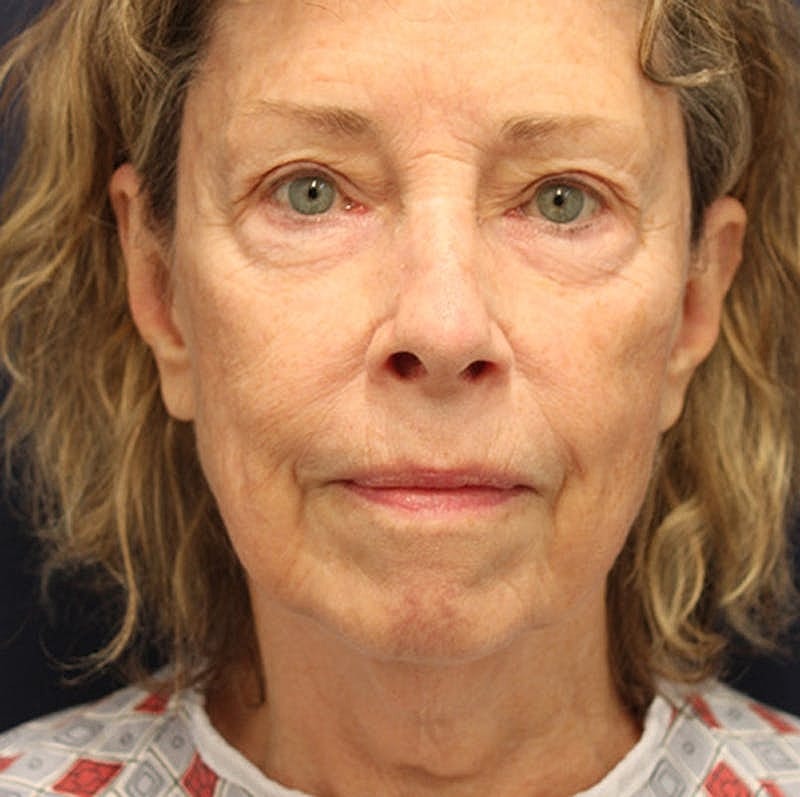 Facelift Before & After