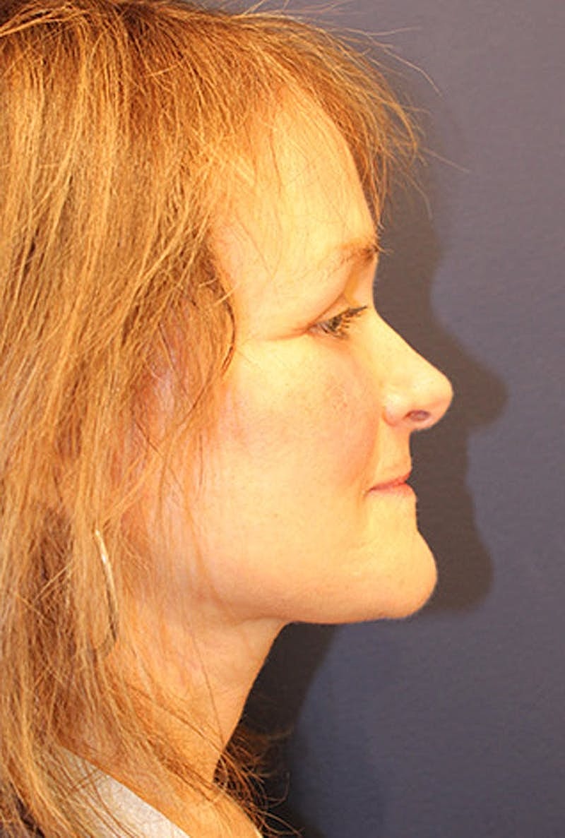 Facelift Before & After