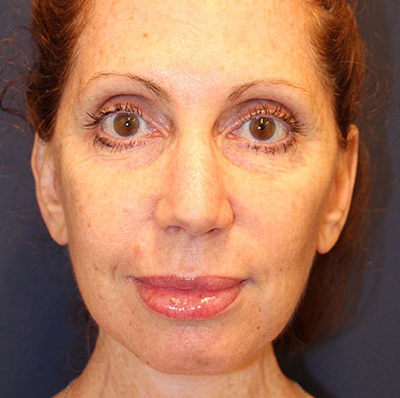 Facelift Before & After
