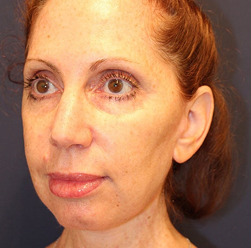 Facelift Before & After