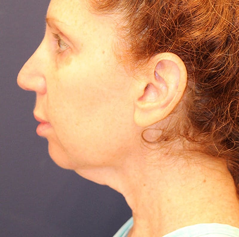 Facelift Before & After