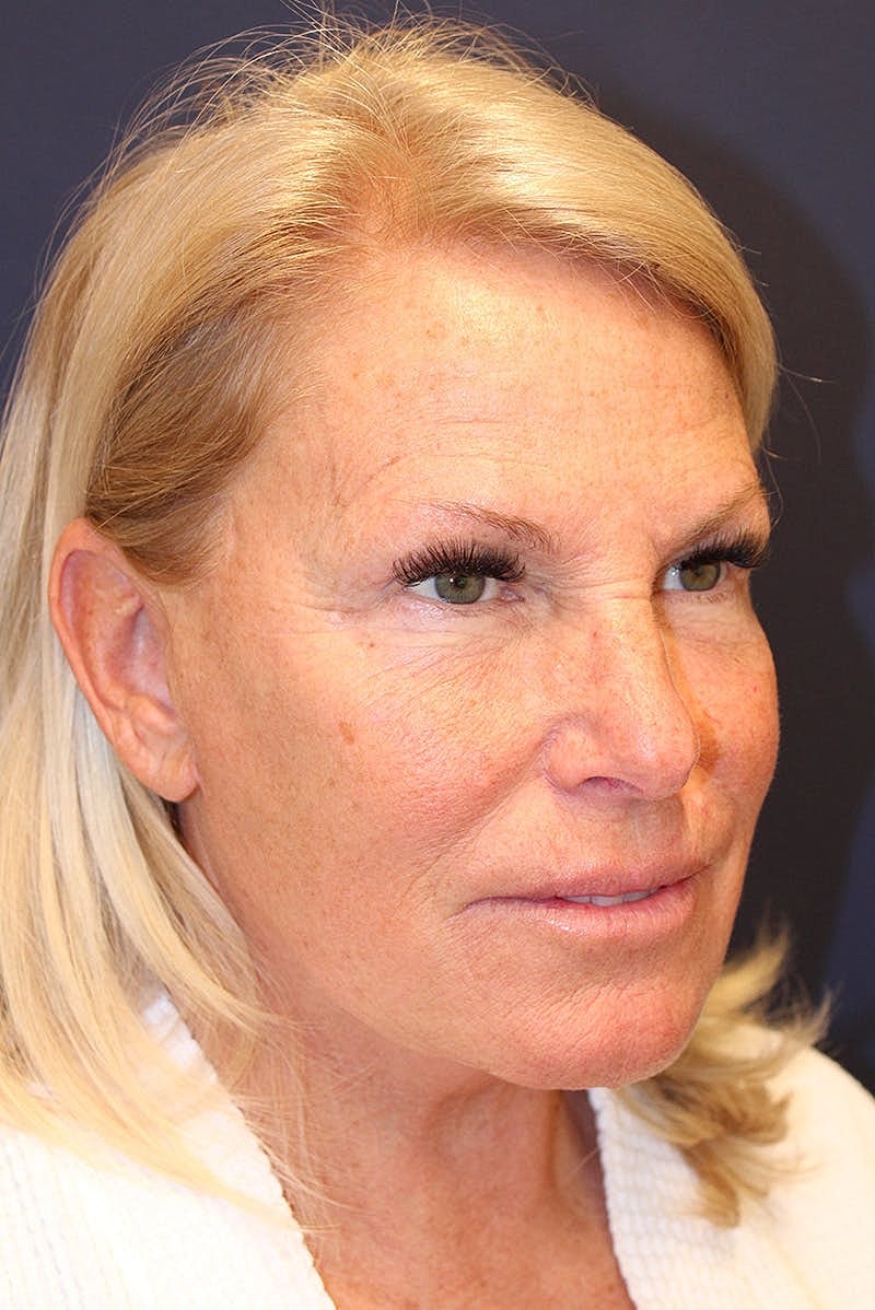 Facelift Before & After