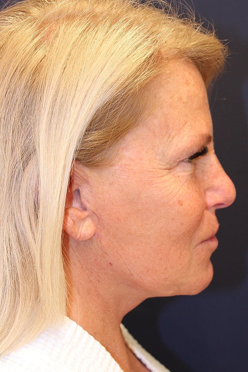 Facelift Before & After