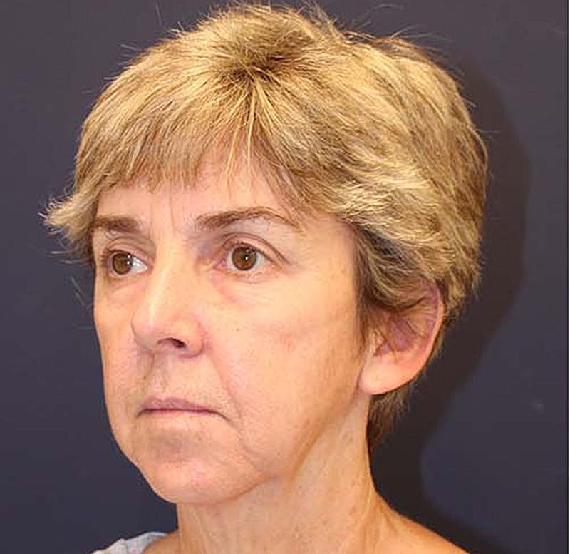 Facelift Before & After