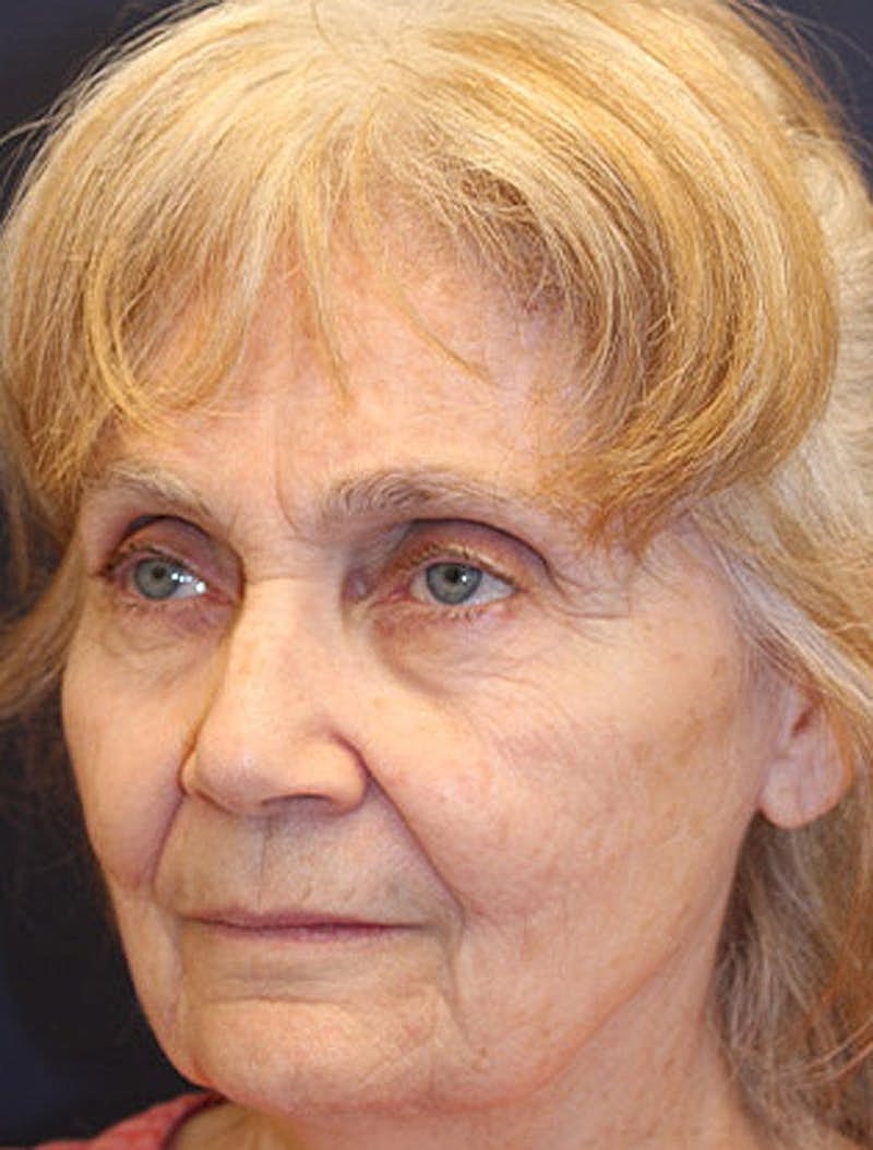 Facelift Before & After