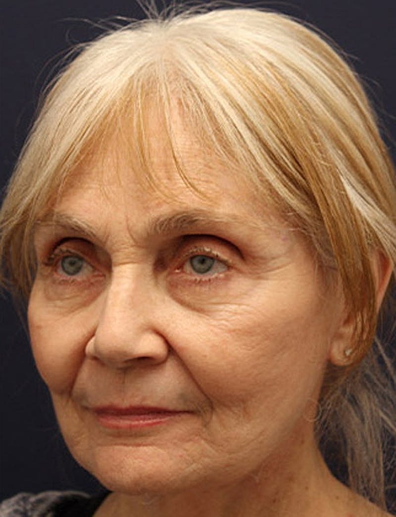 Facelift Before & After