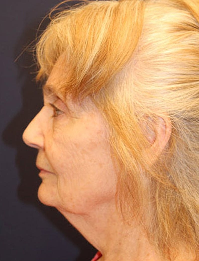 Facelift Before & After
