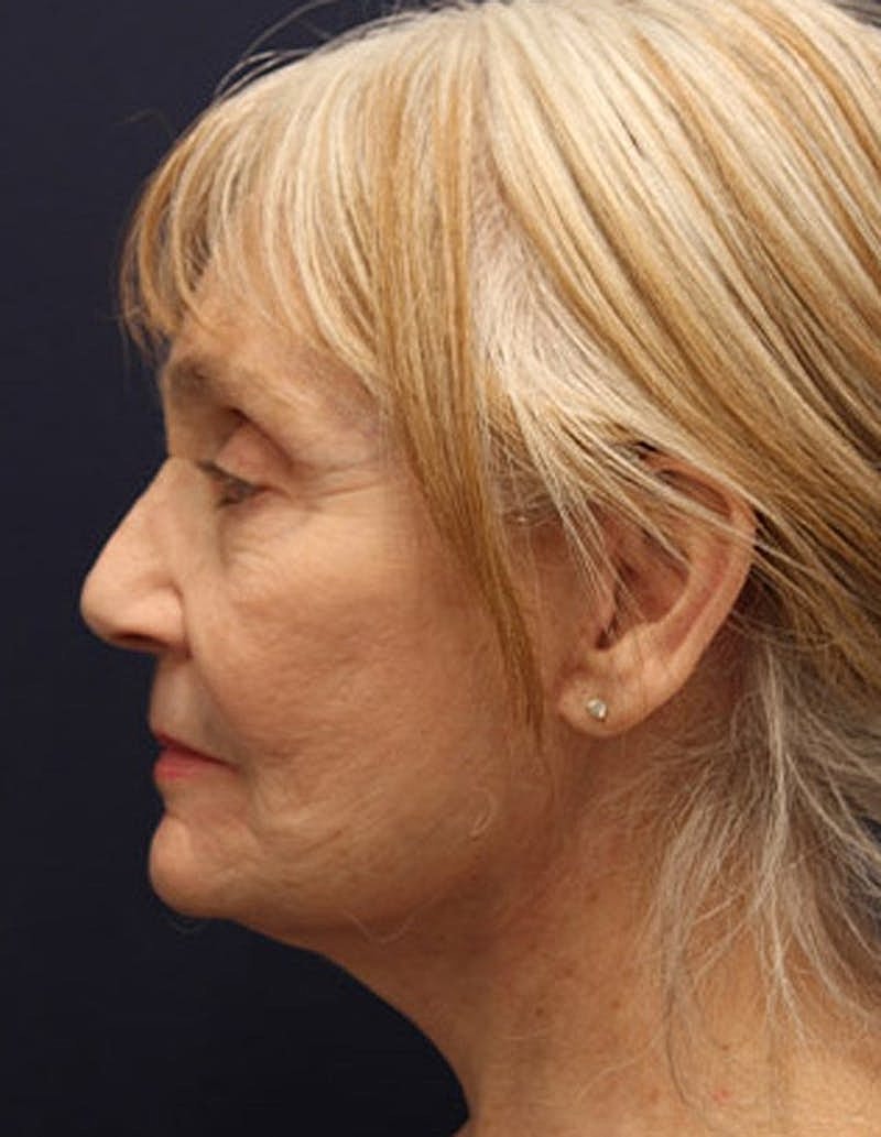 Facelift Before & After