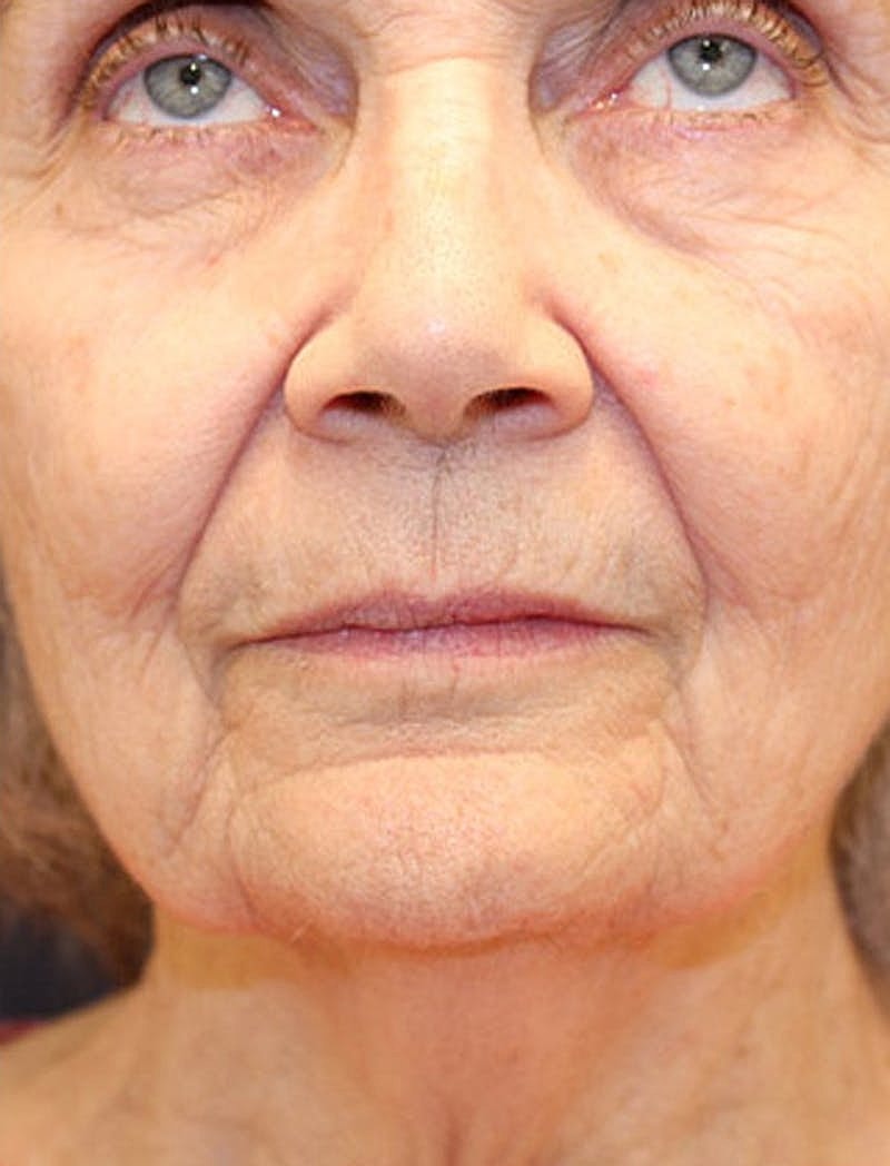 Facelift Before & After