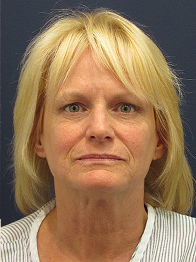 Facelift Before & After