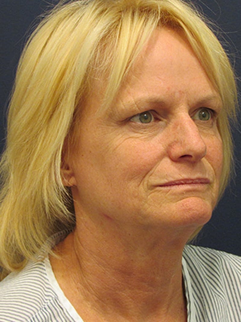 Facelift Before & After