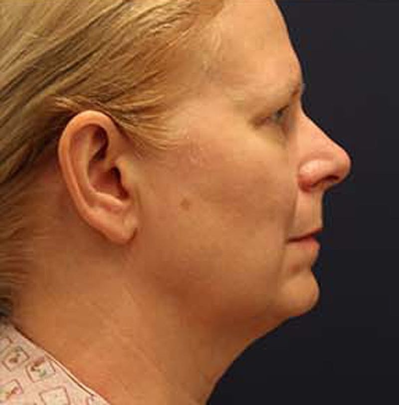 Facelift Before & After