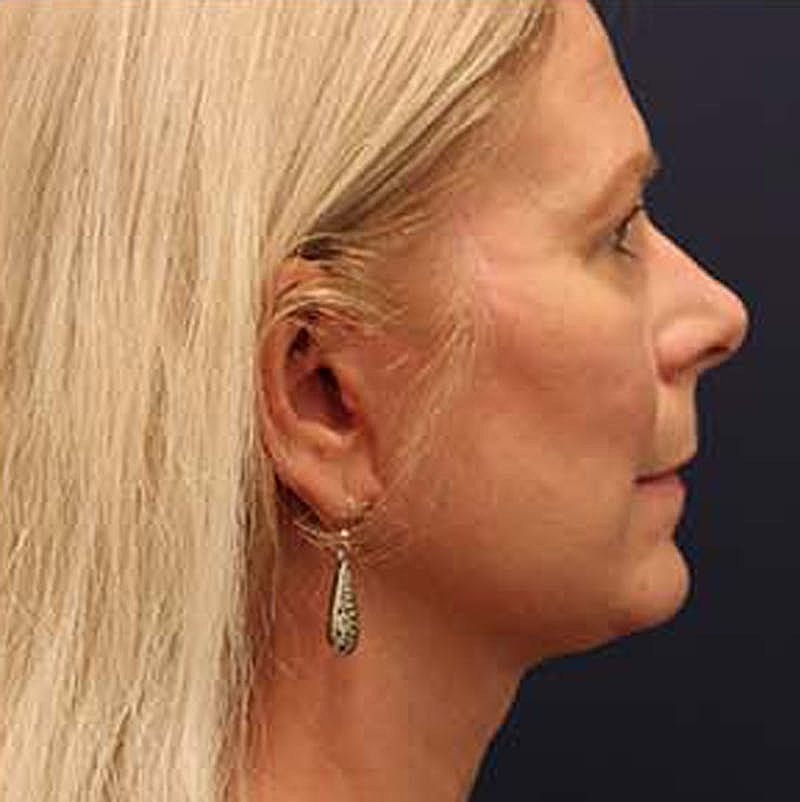 Facelift Before & After