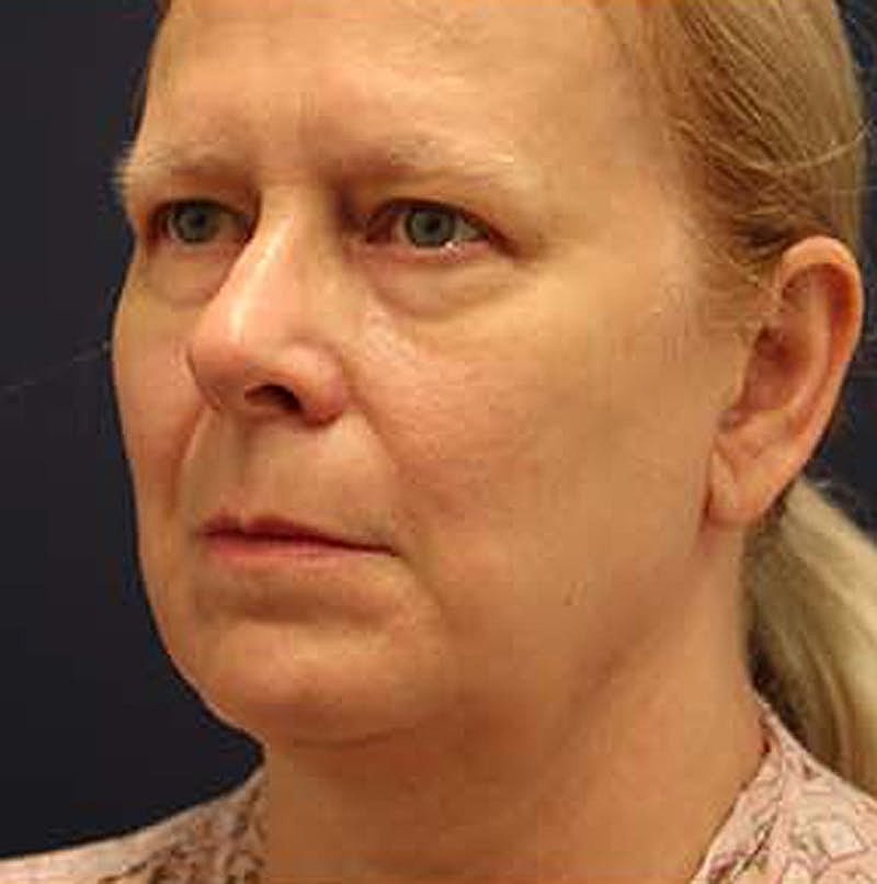 Facelift Before & After