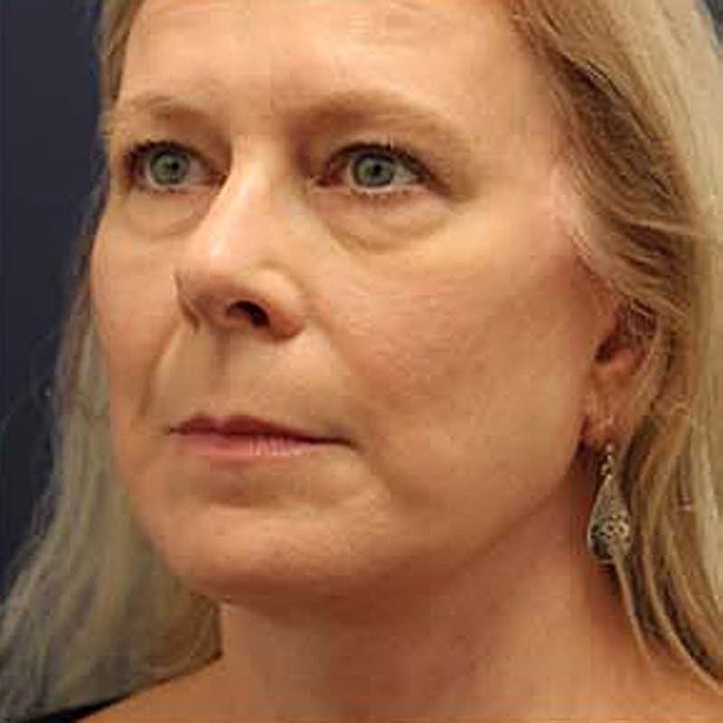 Facelift Before & After