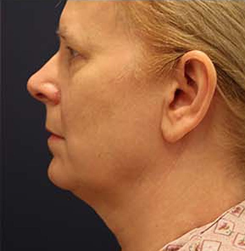Facelift Before & After