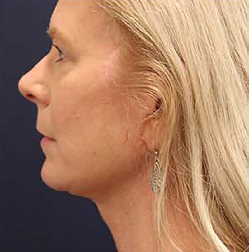 Facelift Before & After