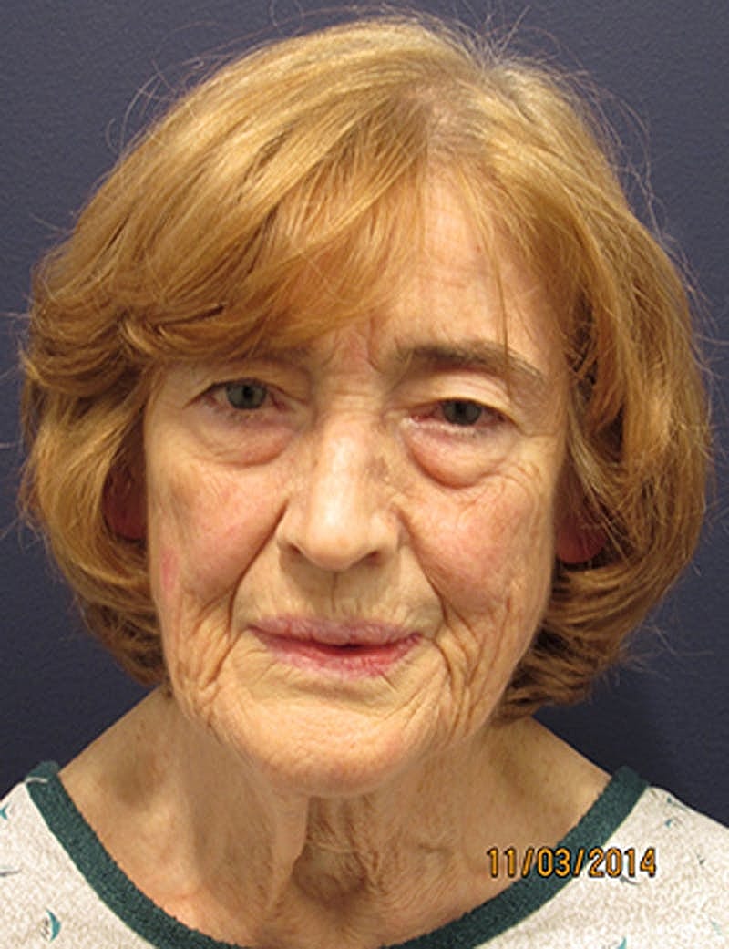 Facelift Before & After