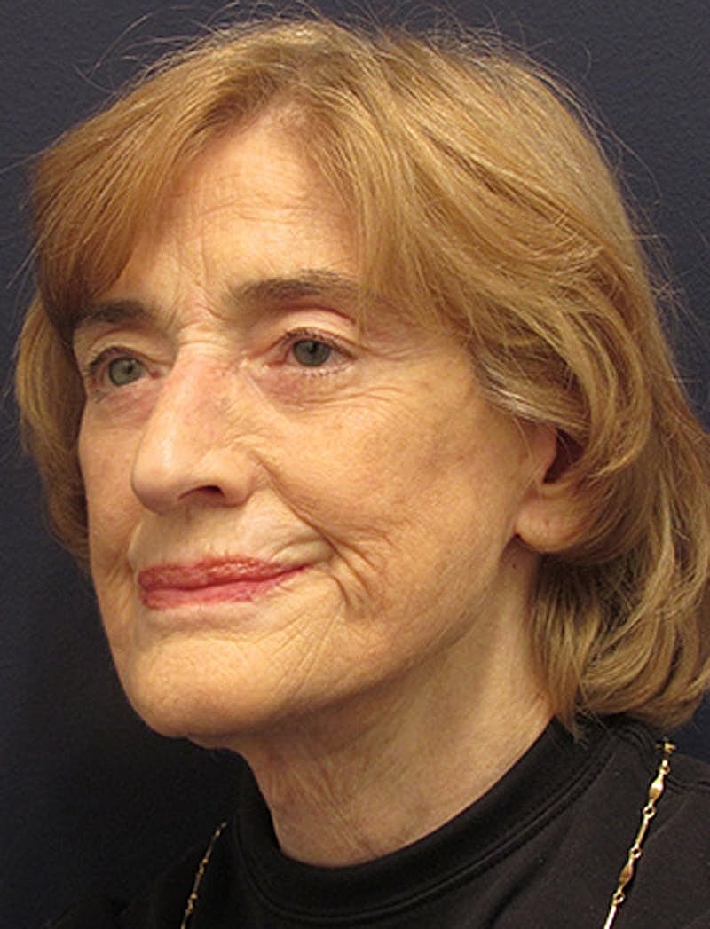 Facelift Before & After