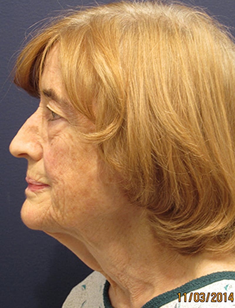 Facelift Before & After