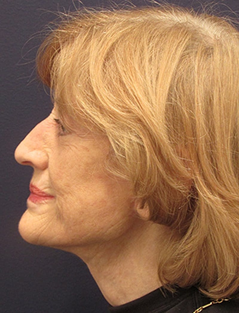 Facelift Before & After