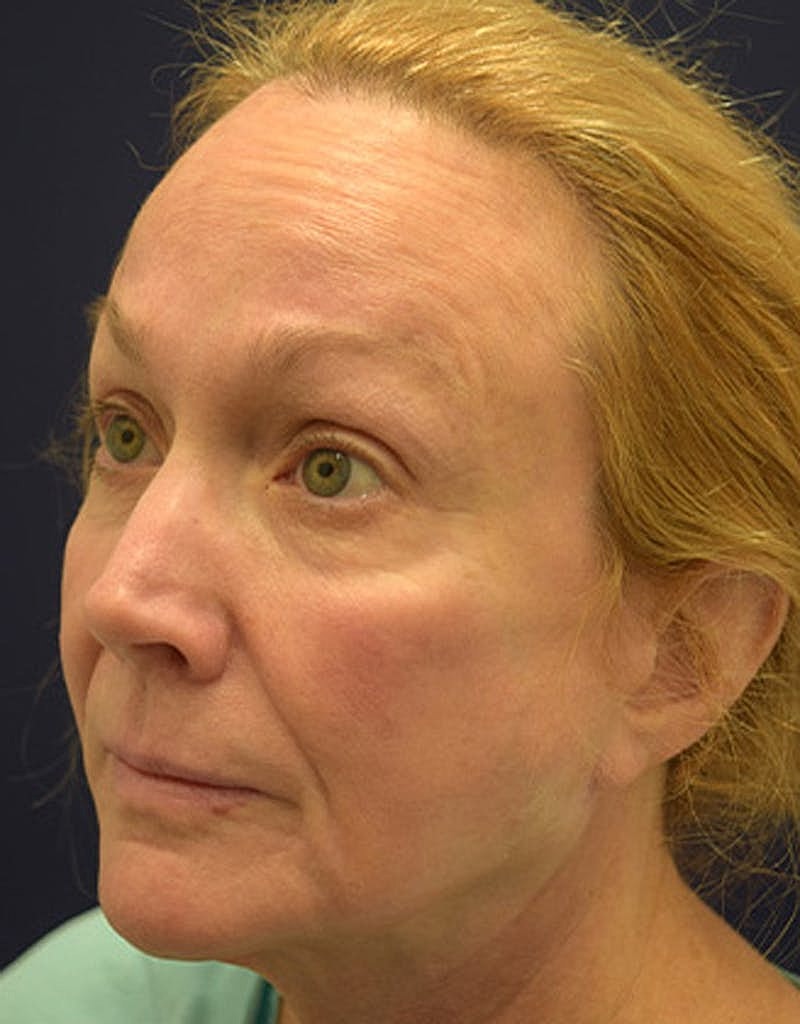 Facelift Before & After