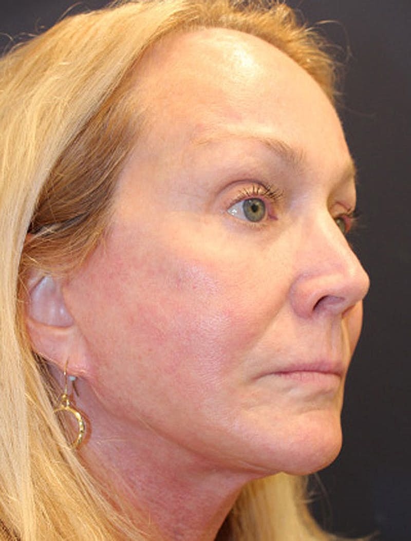 Facelift Before & After
