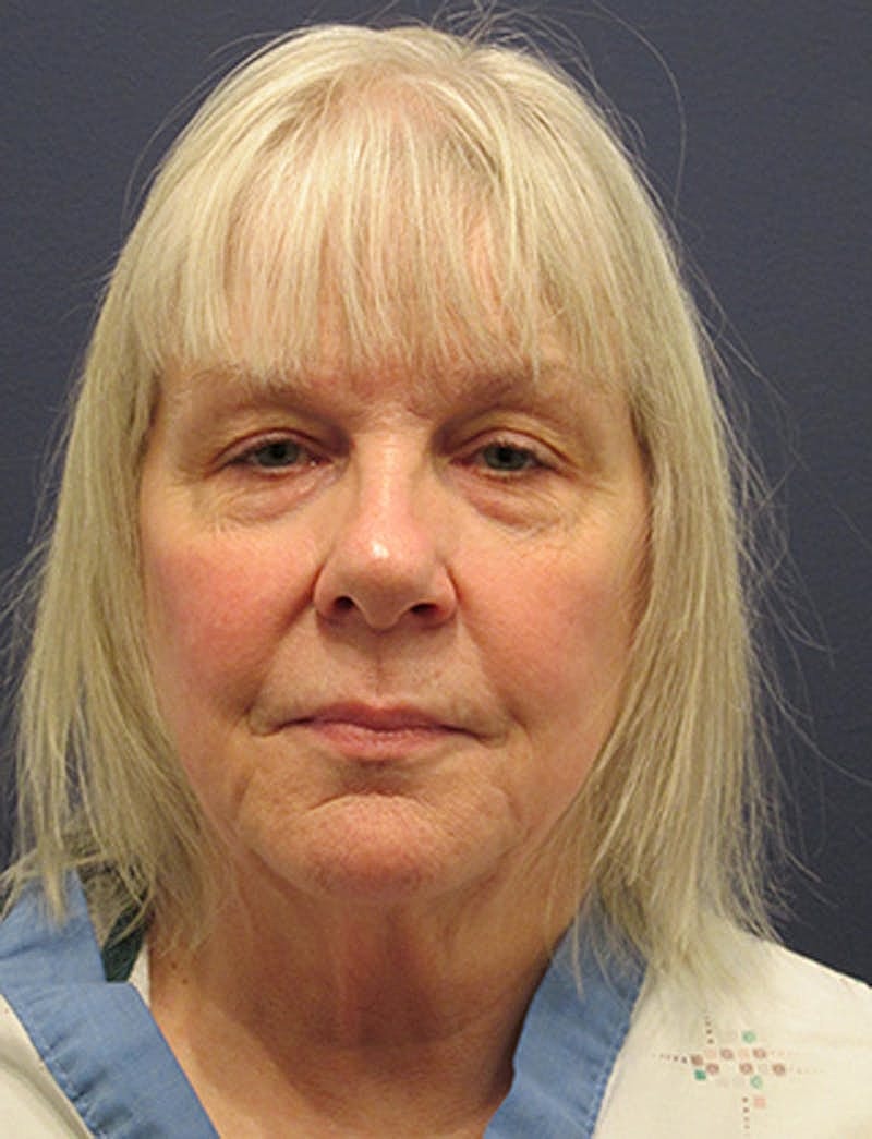 Facelift Before & After