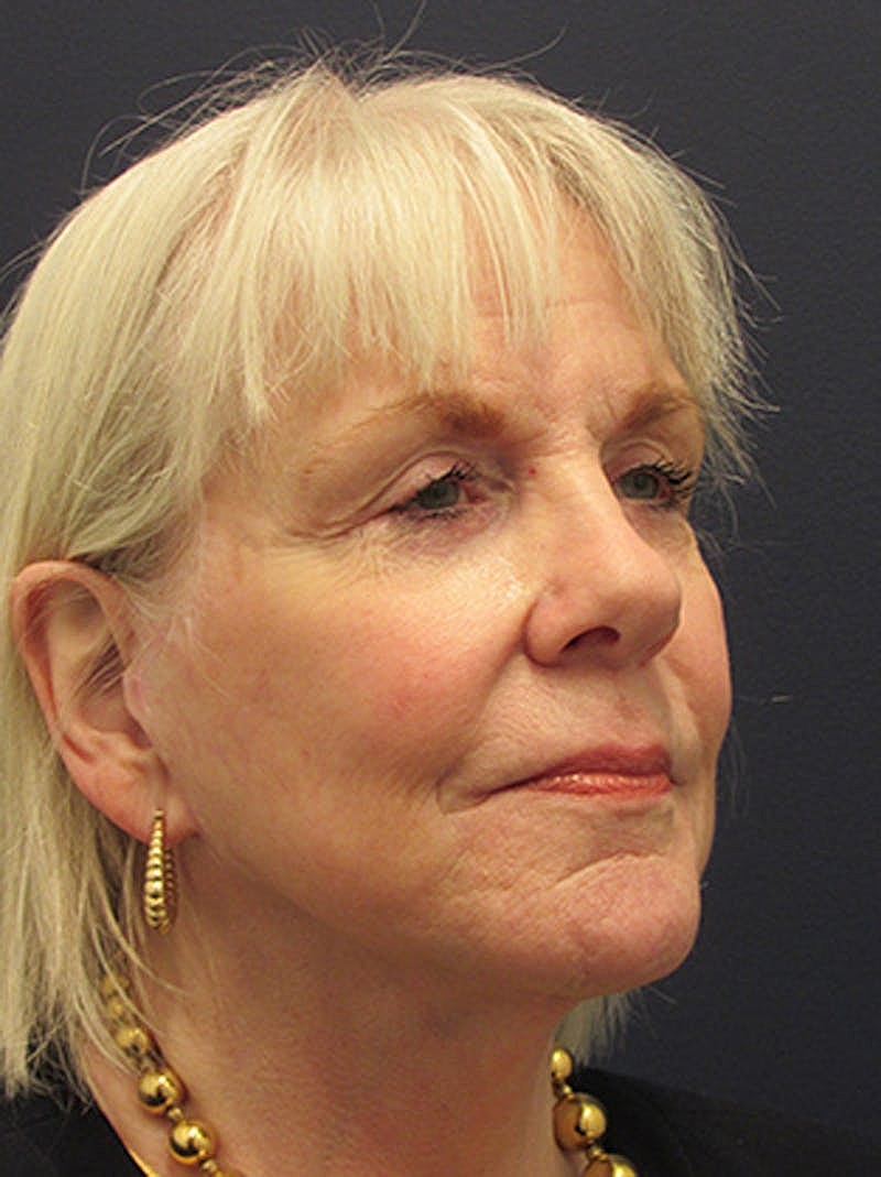 Facelift Before & After