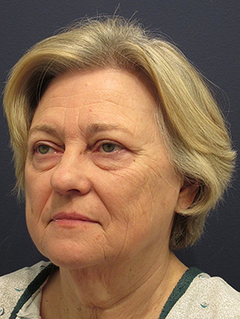 Facelift Before & After