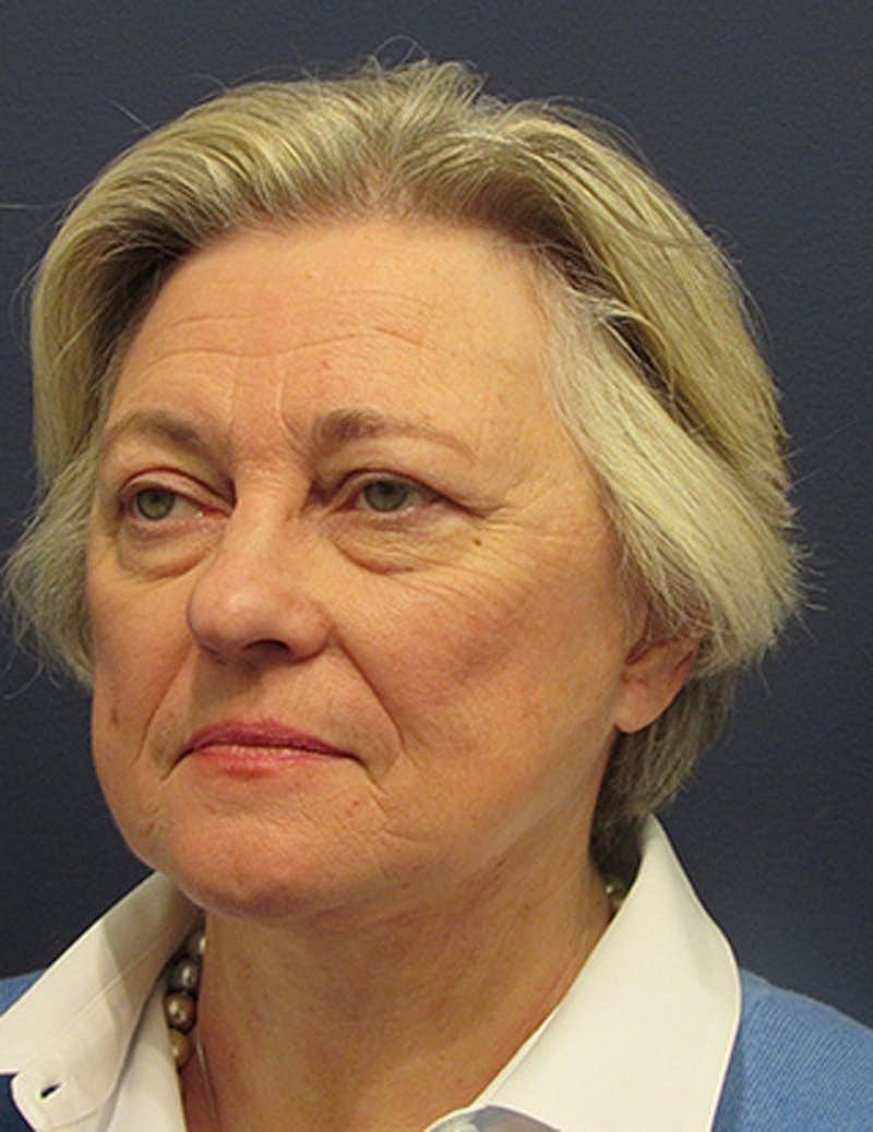 Facelift Before & After