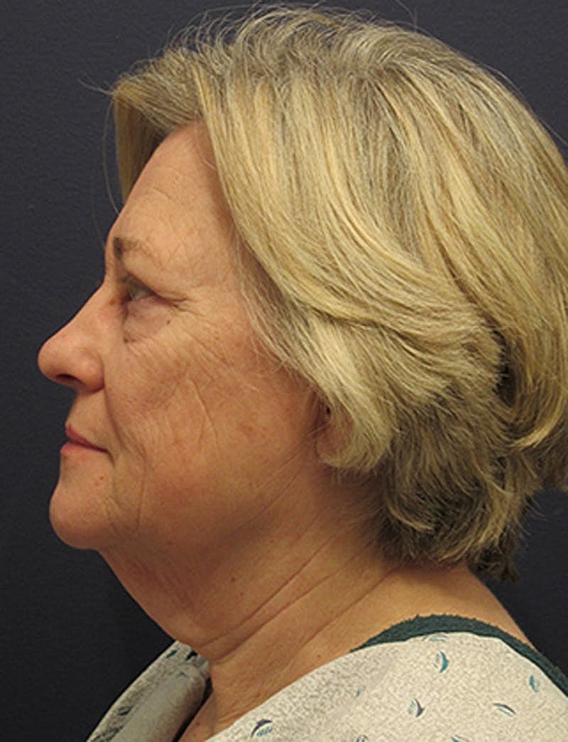 Facelift Before & After