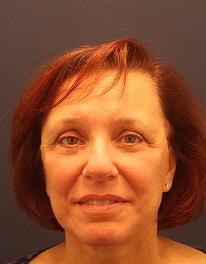 Facelift Before & After