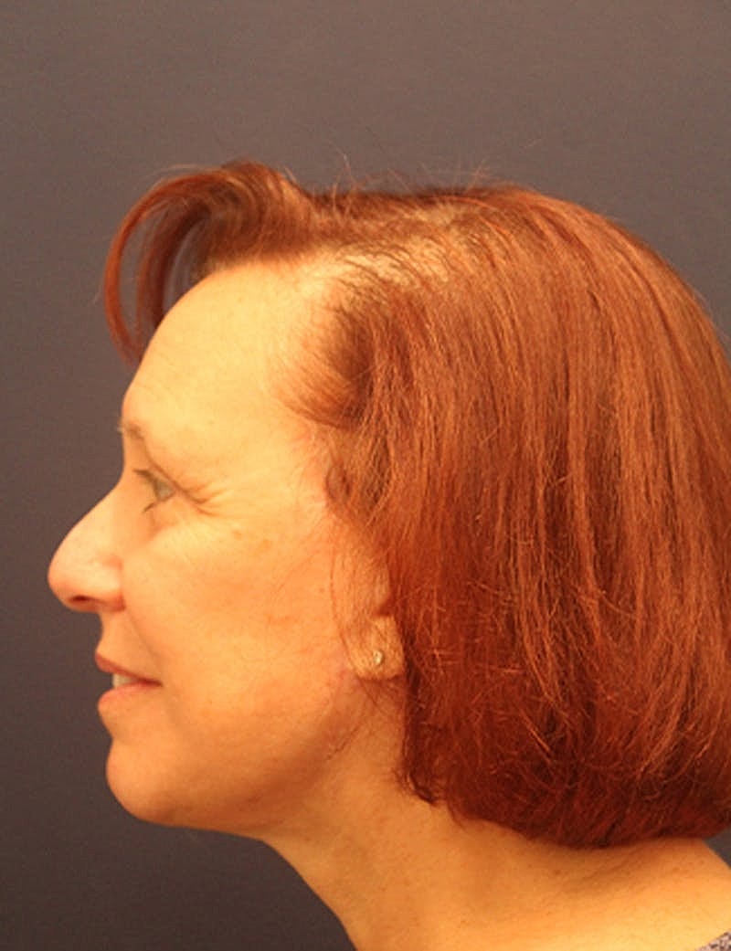 Facelift Before & After