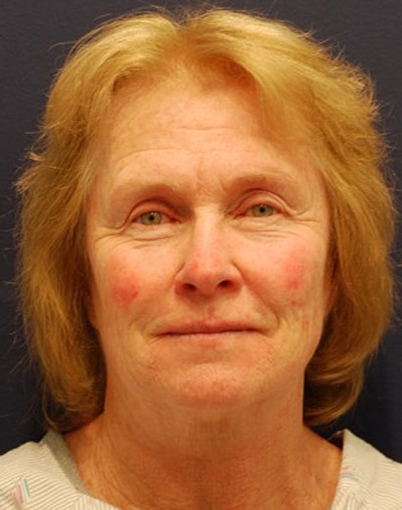 Facelift Before & After