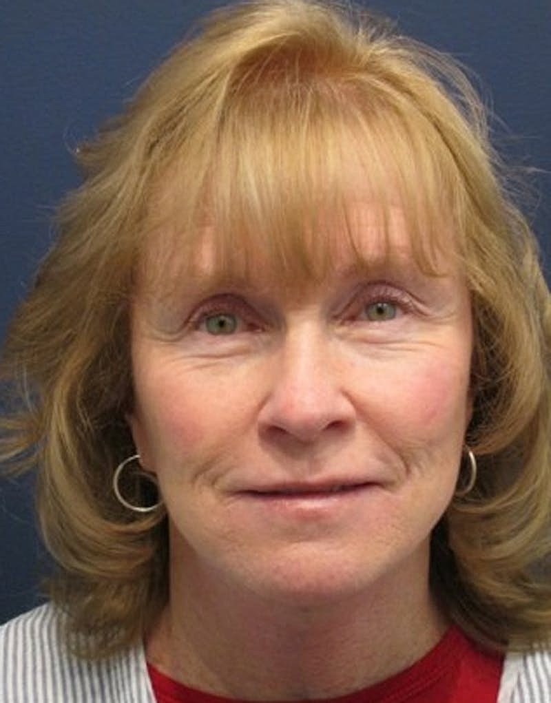 Facelift Before & After