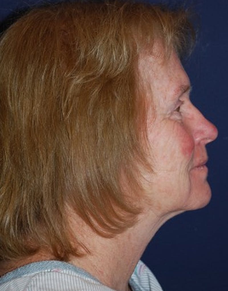 Facelift Before & After